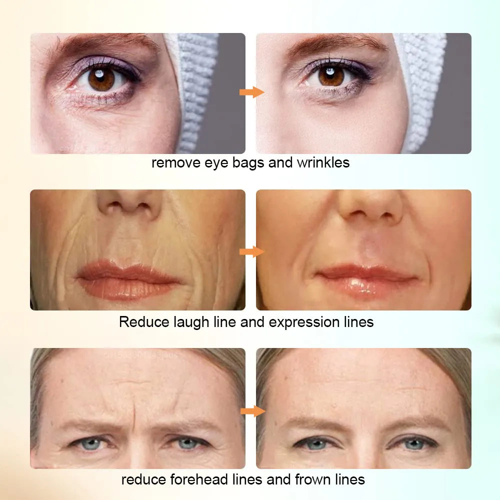 Skin Tightening Face Lifting Device